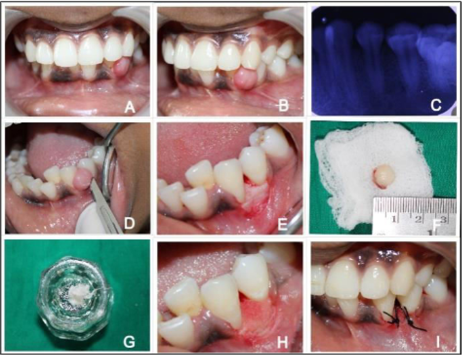 Managemnet of Peripheral Ossifying Fibroma (2025)